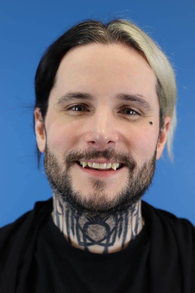 After Image: Open Septorhinoplasty - front