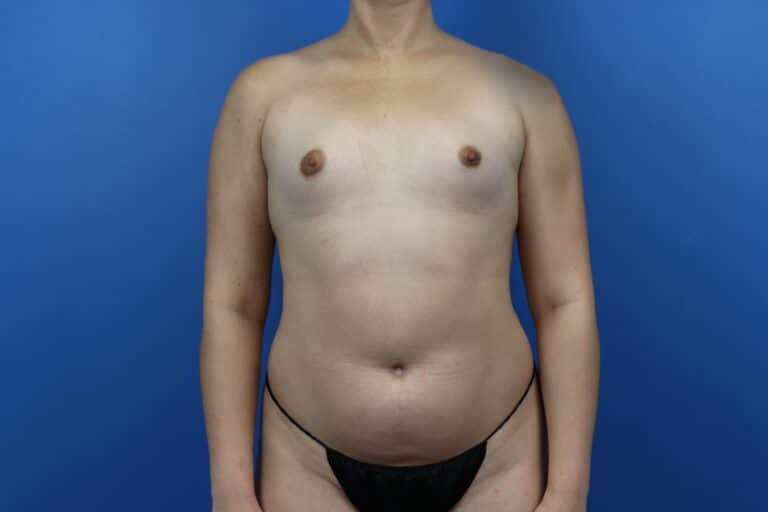 Before Image: Autologous Fat Grafting to Breasts - front
