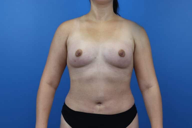 After Image: Autologous Fat Grafting to Breasts - front