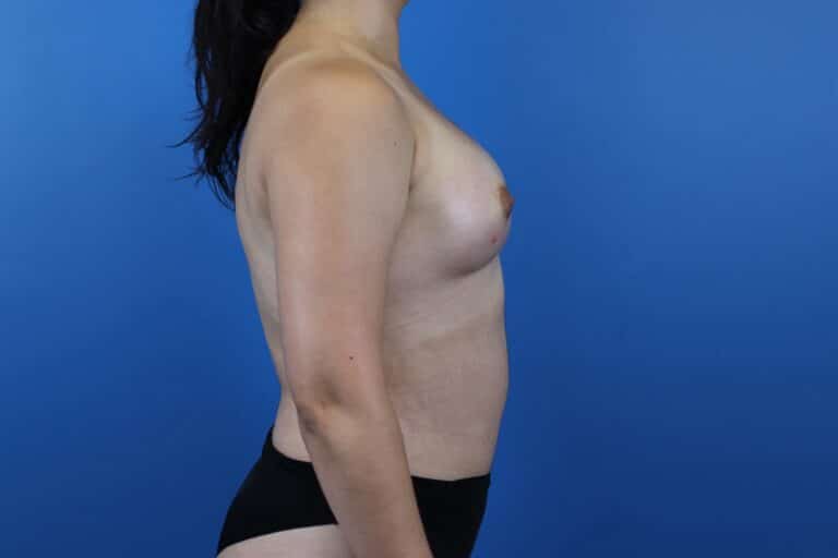 After Image: Autologous Fat Grafting to Breasts - right-side