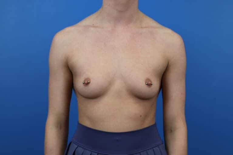 Before Image: Breast Augmentation (Silicone) - front