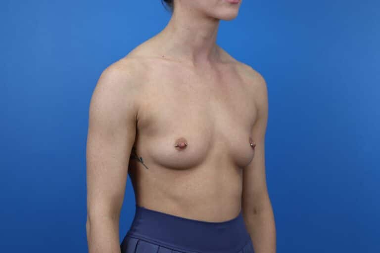 Before Image: Breast Augmentation (Silicone) - right-front-oblique