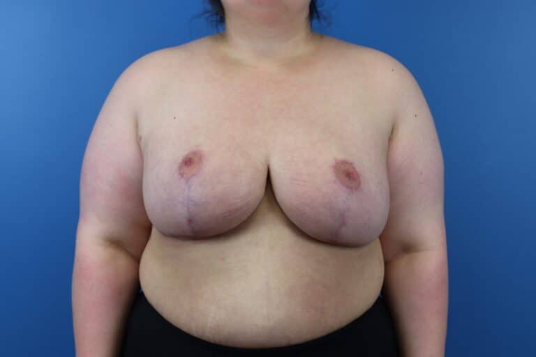 After Image: Breast Reduction with Free Nipple Graft - front