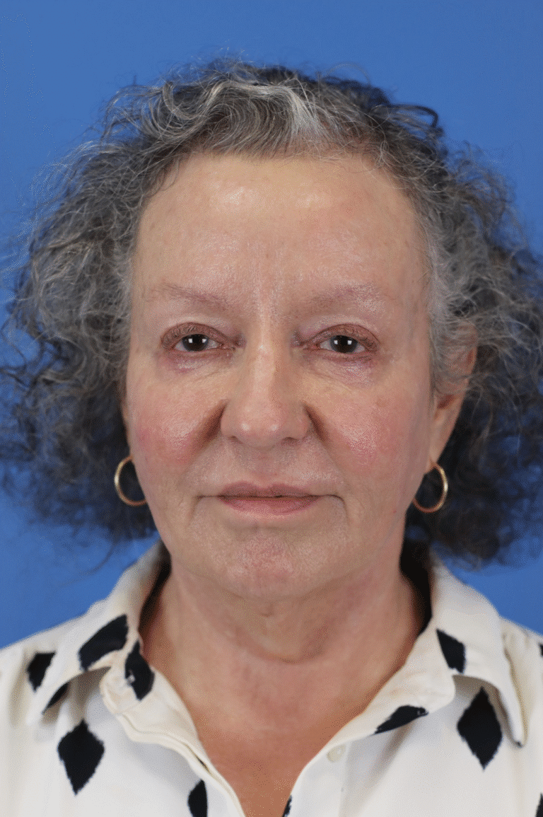 After Image: Junera Subdermal Laser - front