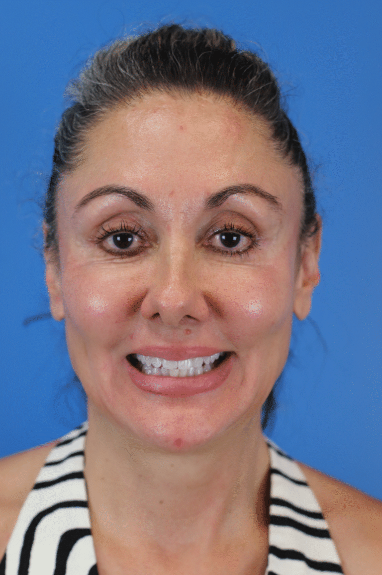 After Image: Junera Subdermal Laser - front
