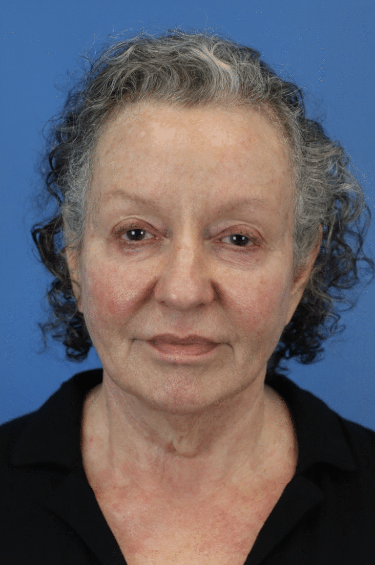 Before Image: Junera Subdermal Laser - front