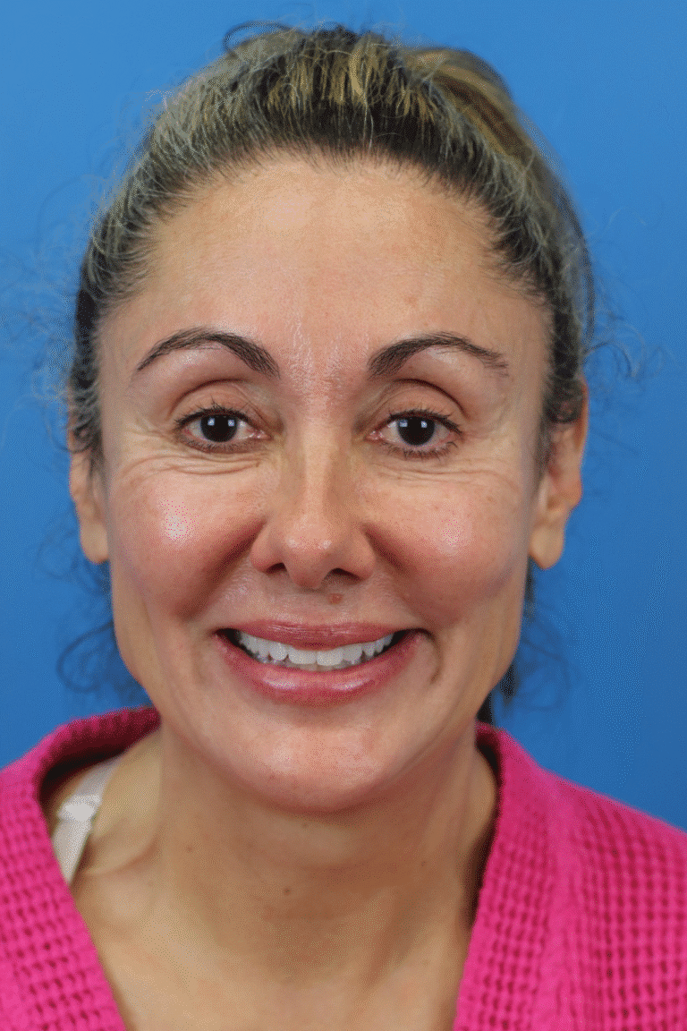 Before Image: Junera Subdermal Laser - front