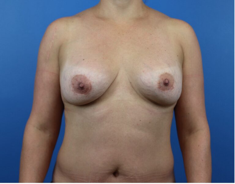 Before Image: Breast Implant Exchange with Fat Grafting - front