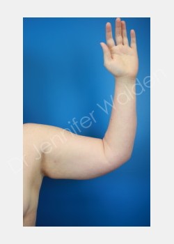 Before Image: liposuction - front