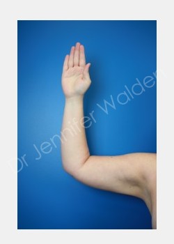 After Image: liposuction - front