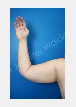 Before Image: liposuction - front