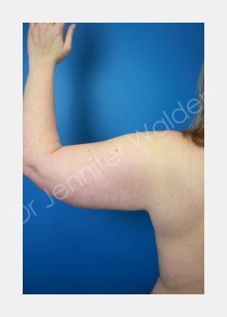 Before Image: liposuction - front