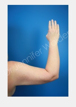 After Image: liposuction - front