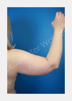 Before Image: liposuction - front