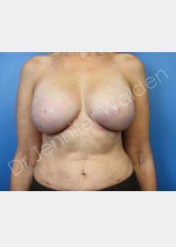 After Image: breast reconstruction - front