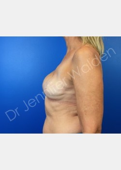 Before Image: breast reconstruction - front