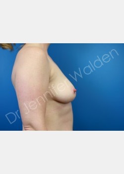Before Image: breast augmentation - front