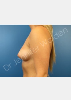 Before Image: breast augmentation - front