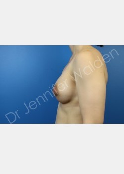 After Image: breast augmentation - front
