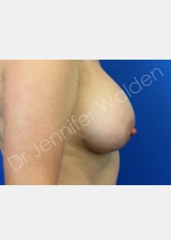 After Image: breast augmentation - front