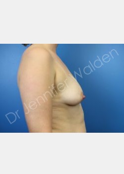 Before Image: breast augmentation - front