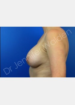 After Image: breast augmentation - front