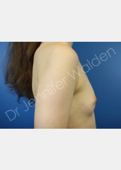 Before Image: breast augmentation - front