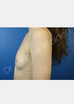 Before Image: breast augmentation - front