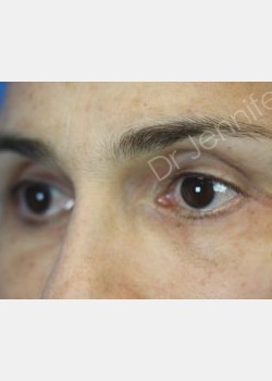 After Image: Blepharolasty - front
