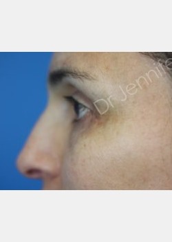 After Image: Blepharolasty - front