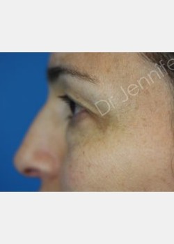 Before Image: Blepharolasty - front