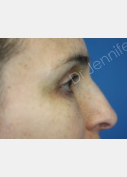 After Image: Blepharolasty - front