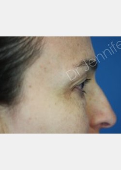 Before Image: Blepharolasty - front