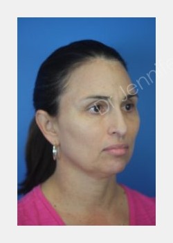 After Image: Blepharolasty - front