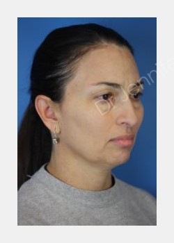 Before Image: Blepharolasty - front