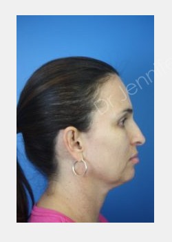 After Image: Blepharolasty - front