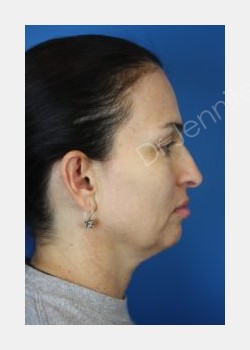 Before Image: Blepharolasty - front