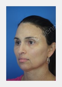 After Image: Blepharolasty - front