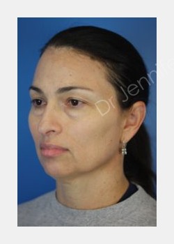 Before Image: Blepharolasty - front