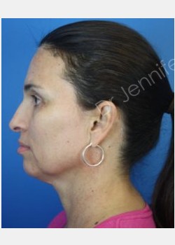 After Image: Blepharolasty - front