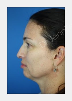 Before Image: Blepharolasty - front