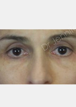 After Image: Blepharolasty - front