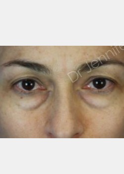 Before Image: Blepharolasty - front