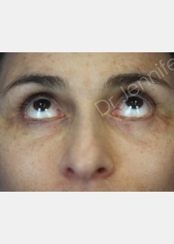 After Image: Blepharolasty - front