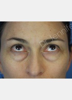 Before Image: Blepharolasty - front