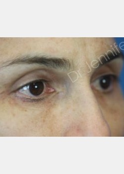 After Image: Blepharolasty - front