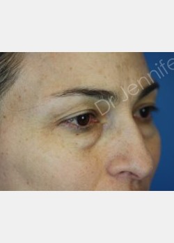 Before Image: Blepharolasty - front