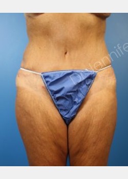 After Image: abdominoplasty - front