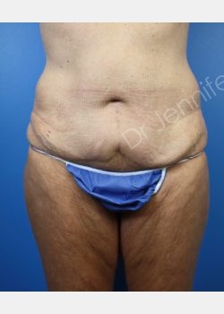 Before Image: abdominoplasty - front