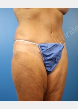 After Image: abdominoplasty - front
